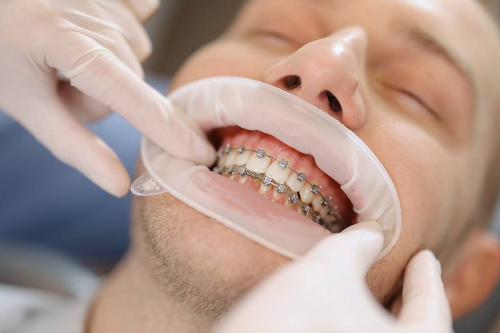 O uso de um aparelho dentário oferece benefícios duradouros que vão além de um sorriso alinhado. Não há limite de idade para iniciar o tratamento.