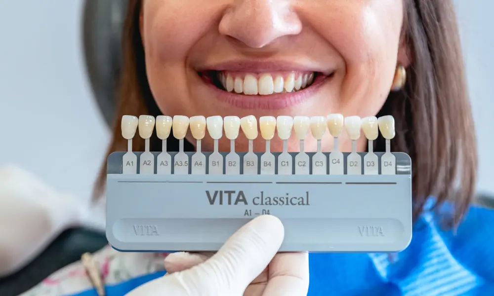 Dentes alinhados e brancos em resultado de branqueamento dentário estético.
