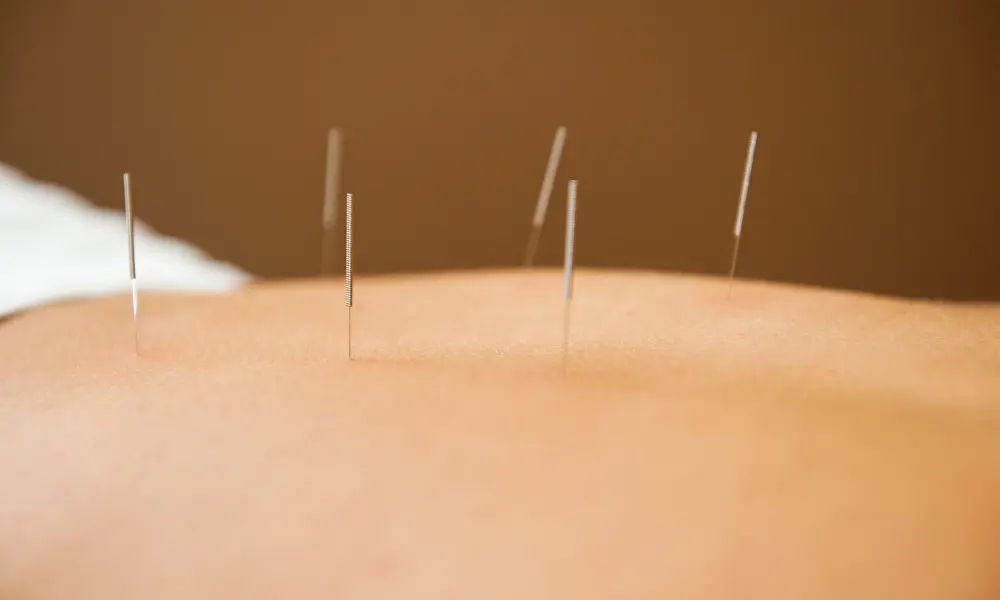 Acupuntura realizada por profissionais qualificados com agulhas esterilizadas e práticas seguras em ambiente clínico.