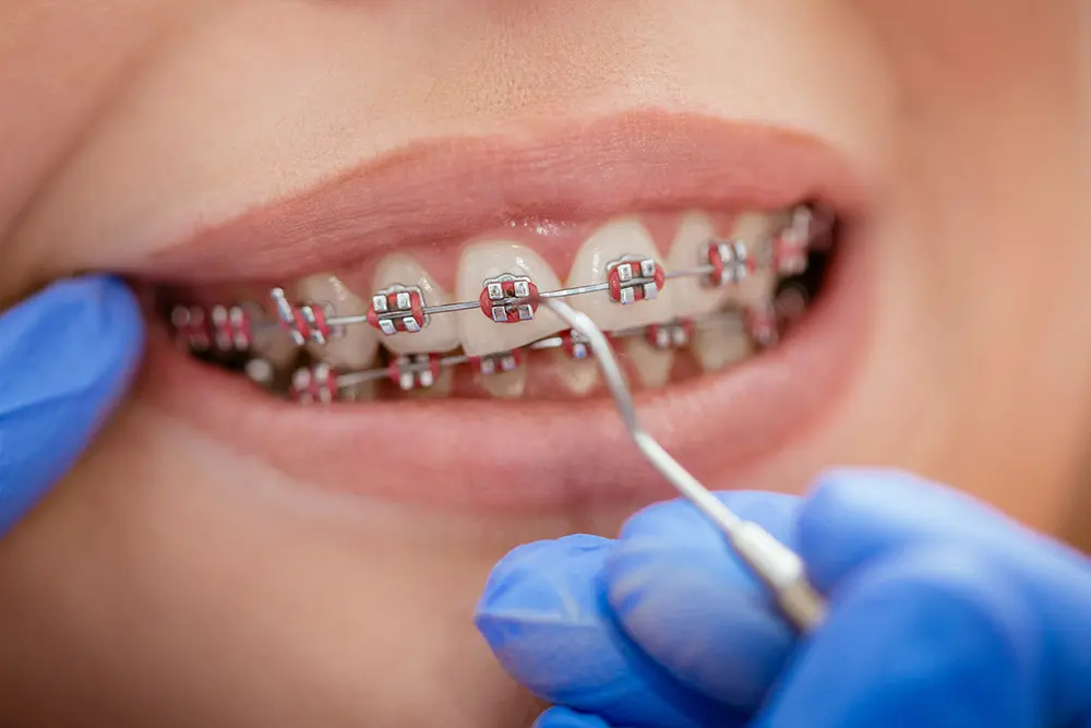 Indicações dos aparelhos ortodônticos para corrigir dentes desalinhados, apinhamento, espaçamentos e problemas de mordida.