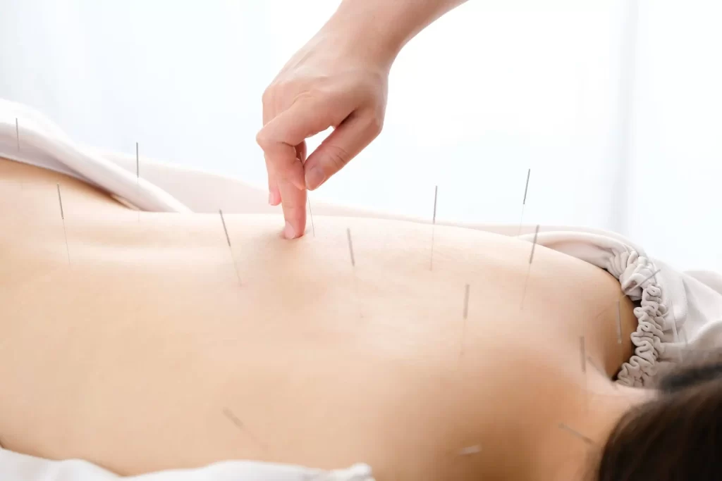 Sessão de acupuntura com agulhas finas aplicadas em pontos específicos do corpo para promover equilíbrio e bem estar geral.