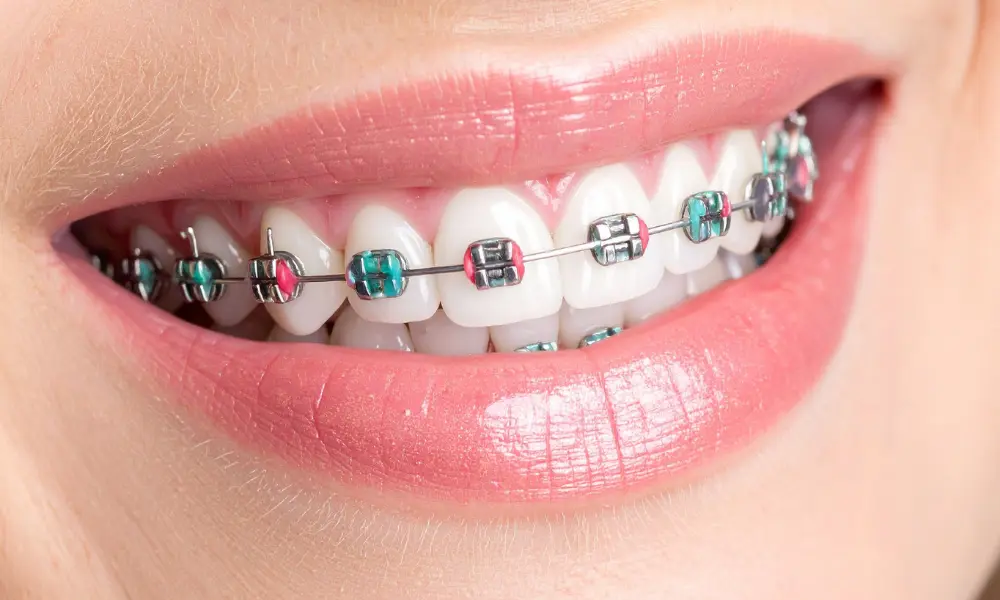Aparelho dentário convencional com bráquetes metálicos e arco ortodôntico fixo utilizado para corrigir desalinhamento e problemas de oclusão