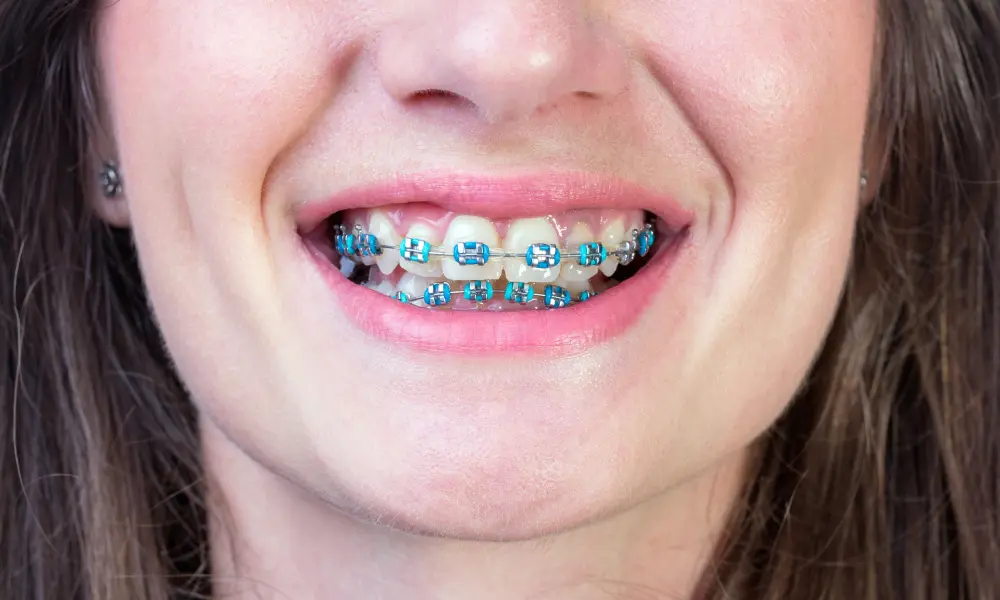 Comparação entre aparelho dentário convencional e alinhadores transparentes, destacando diferenças de estética, conforto e eficácia em casos simples e complexos.