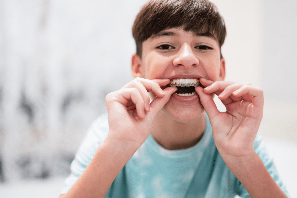 Aparelhos para os dentes das crianças: saiba quando é necessário usar