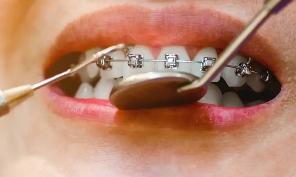 Que Aparelho Dentário Devo Escolher? Entenda neste artigo a diferença entre o aparelho autoligado e o convencional. Consulte o seu dentista!