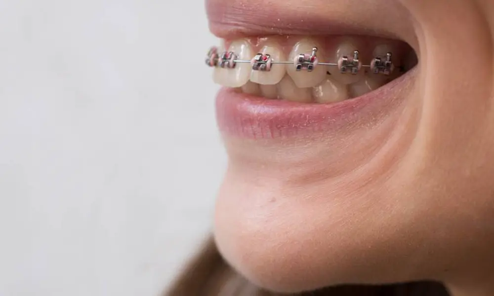 Aparelho Autoligado: A Inovação Autoligável