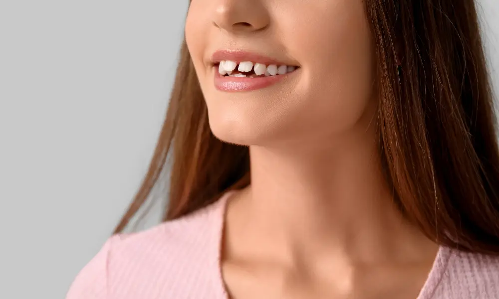 Diastema: Descubra as causas e as opções de tratamento para o espaço entre os dentes. Correção dentária com ou sem aparelho.