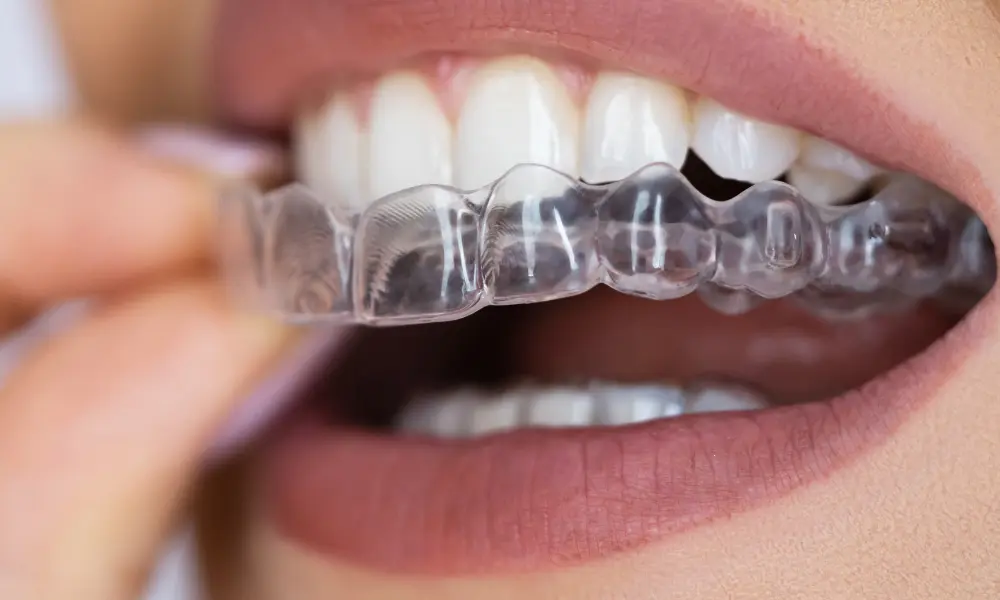 Alinhadores invisíveis são discretos e quase impercetíveis no dia a dia. Veja como a senhora coloca o aparelho transparente, mantendo a estética e a confiança durante todo o tratamento. Consulte o seu dentista!