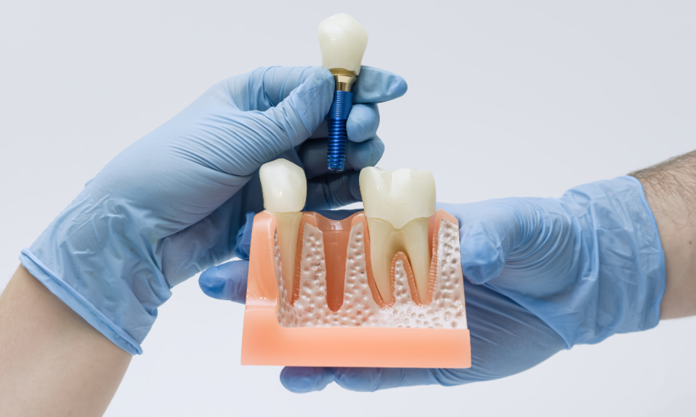 implantes-dentarios-sem-parafuso na clinica do catassol na maia