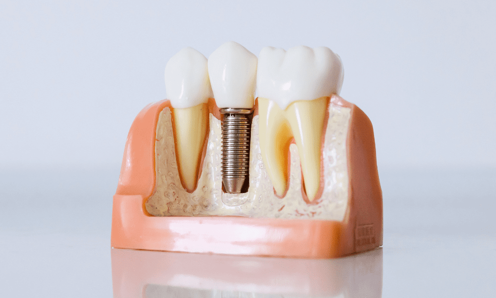 tipos-de-implantes dentários na clínica catassol da maia