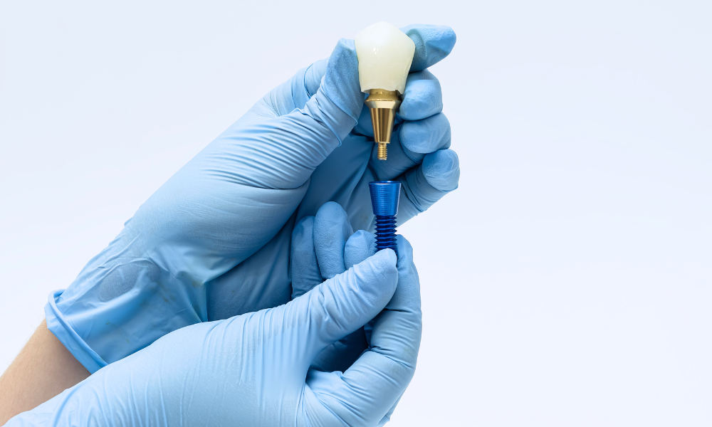 implantes-carga-imediata