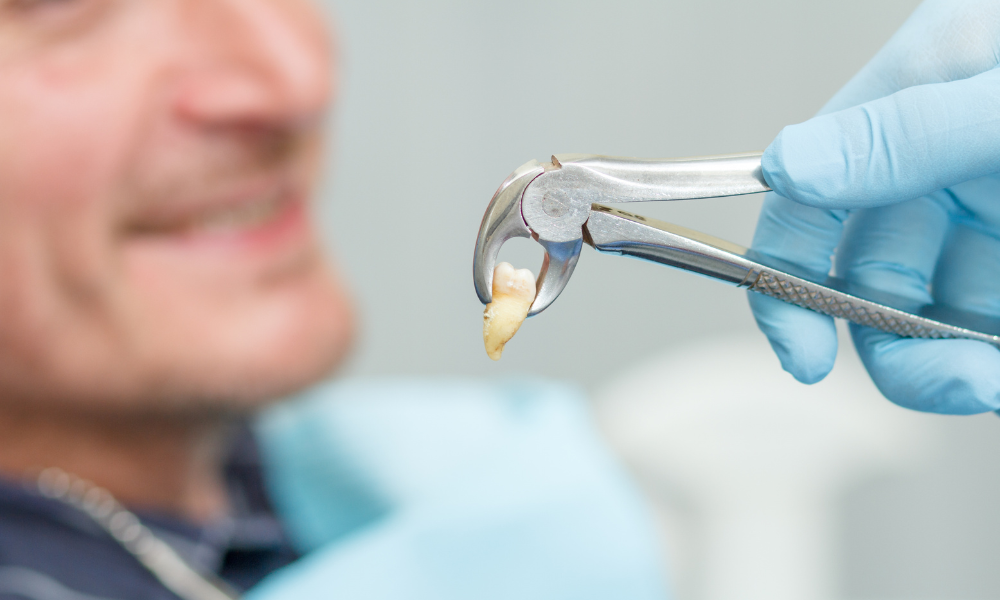 Instrumento dentário a segurar um dente do siso após extração em contexto clínico.