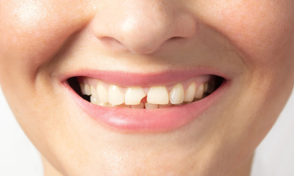 Sorriso com dente partido ou lascado antes de avaliação dentária.